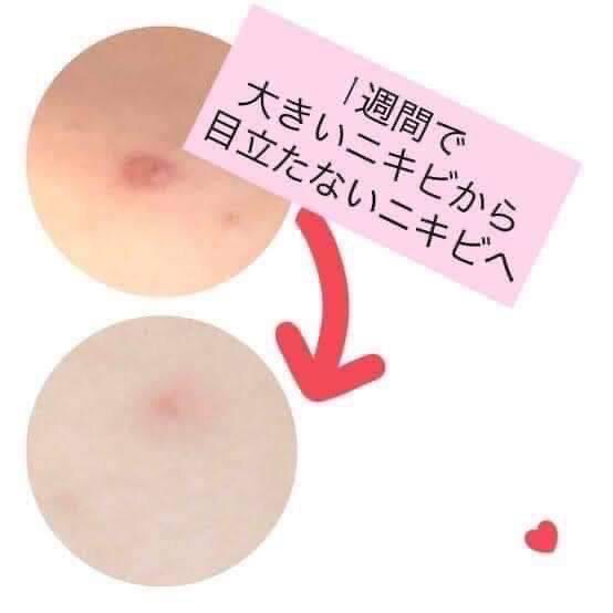 ðĨ(New)ðĨāļāļąāļ§āļŦāļīāļĄāļ°āļāļĩāđāļāļļāđāļ(āđāļāļāļāļĢāļ°āļāļļāļ) | Oronine H Ointment āļāļĢāļĩāļĄāđāļāļāļāļāļĢāļ°āļŠāļāļāđāļāļēāļāļāļĩāđāļāļļāđāļ