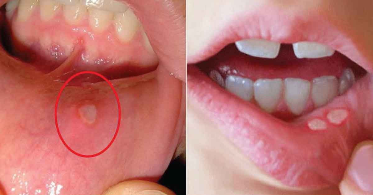 🔥ครีมทาแก้ร้อนในและแผลในช่องปาก Konai-en Taisho Quick Care Cream(เห็นผลได้ไวกว่า)💥ขนาด 5 กรัม