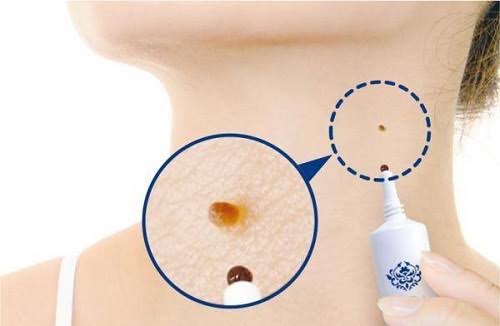 Tsubuporon Night Patch 20g. ครีมแต้มขจัดติ่งเนื้อ ตัวยาจากสมุนไพรถึง 46 ชนิดปลอดภัย ไม่แสบ