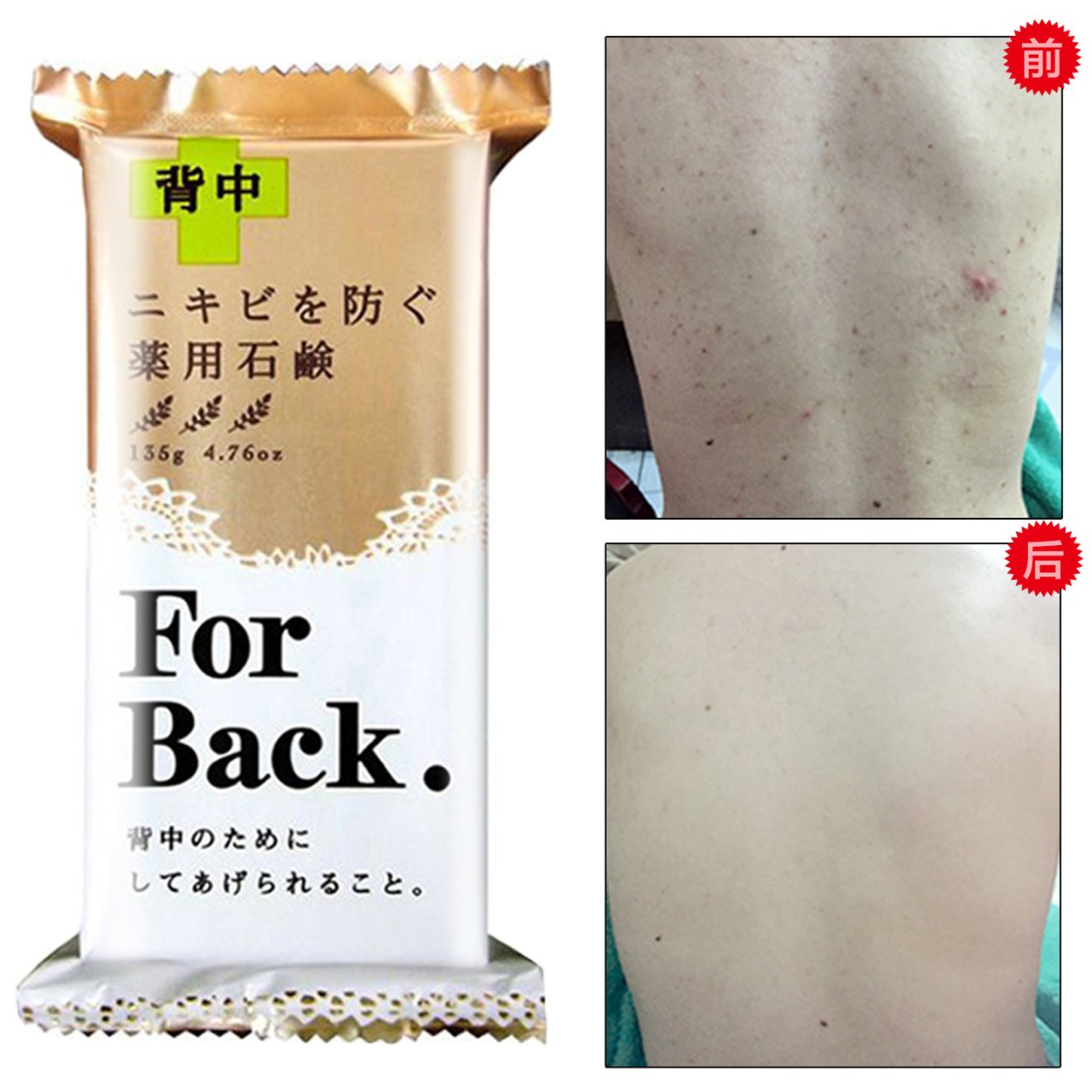 🔥(New Item)💥สบู่รักษาสิวที่หลัง เดตันเซกิ แอคเน่ โซป ฟอร์ แบค | Deitanseki Acne Soap For Back💥 ขนาด 135g.