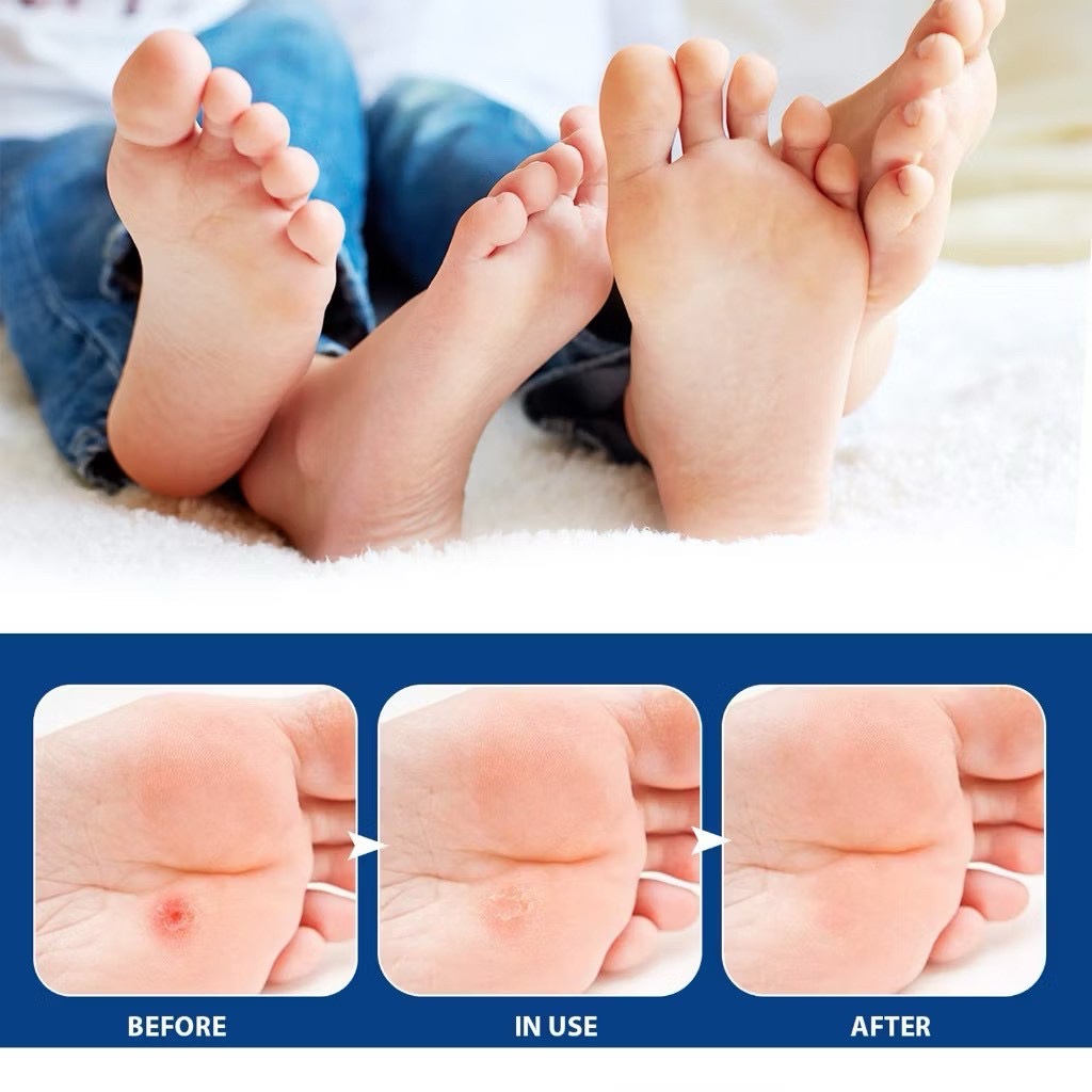 แผ่นแปะตาปลาญี่ปุ่น ใช้รักษาตาปลาและหูด พร้อมตัวยากรดซาลิไซลิก ช่วยให้ผิวหนังส่วนที่แข็งๆ อ่อนตัวนุ่มลง✨ บรรจุ 12 ชิ้น