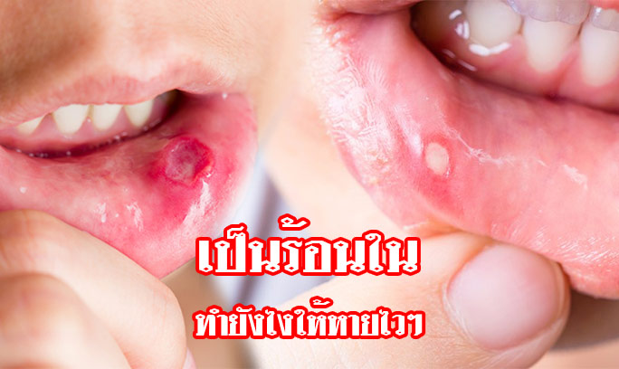 🔥TAISHO Stomatitis Ointment 6g. ยาทาครีมทาแก้ร้อนในและแผลในช่องปาก✨ติดแน่น ไม่แสบ แผลหายเร็ว ไม่มีสารสเตียรอยด์💥ขนาด 6 กรัม