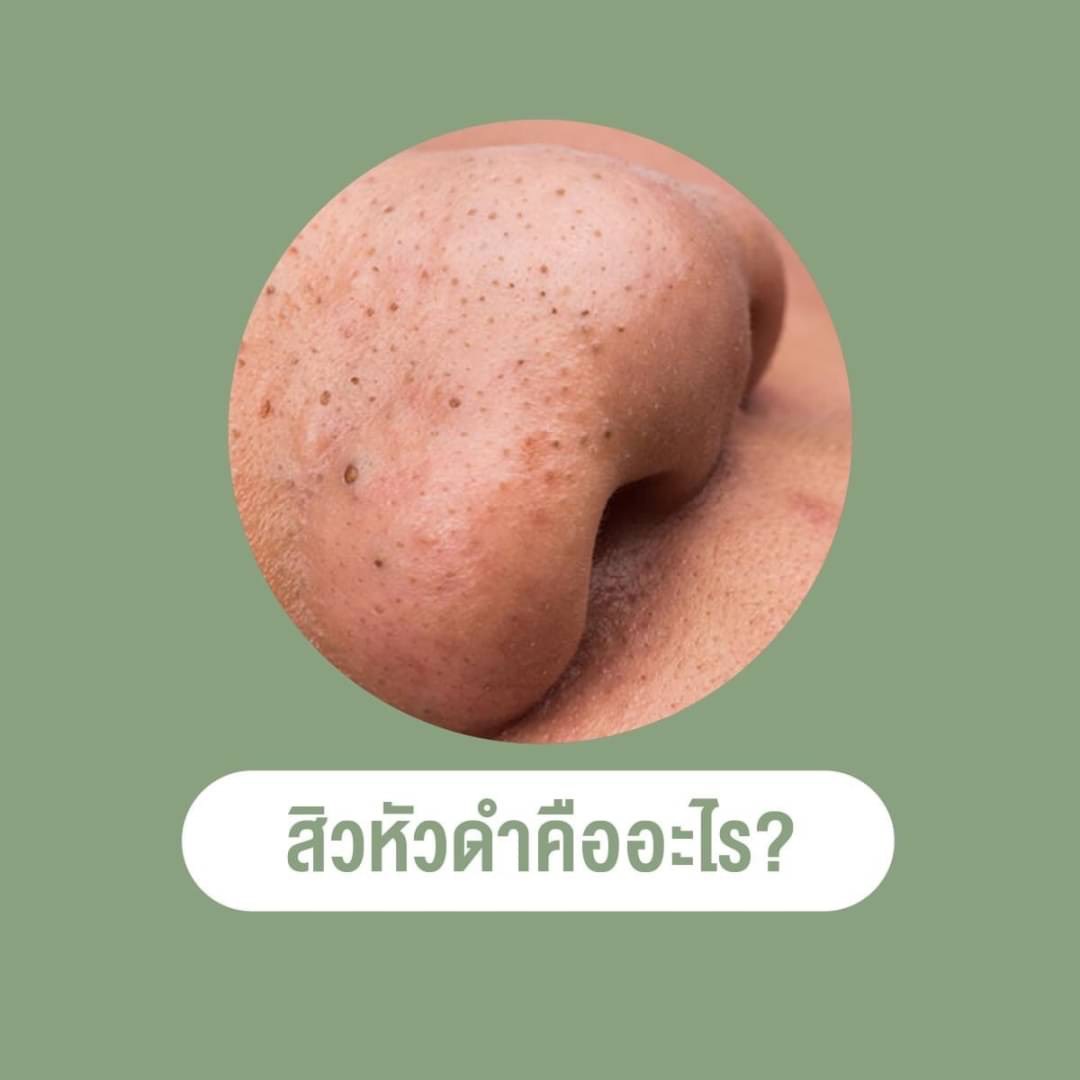 🔥(Hot Item)💥ครีมลอกสิวเสี้ยน Nakiz Lively Nose Green Tea💥ขนาด 15g. บรรจุ 50 แผ่น